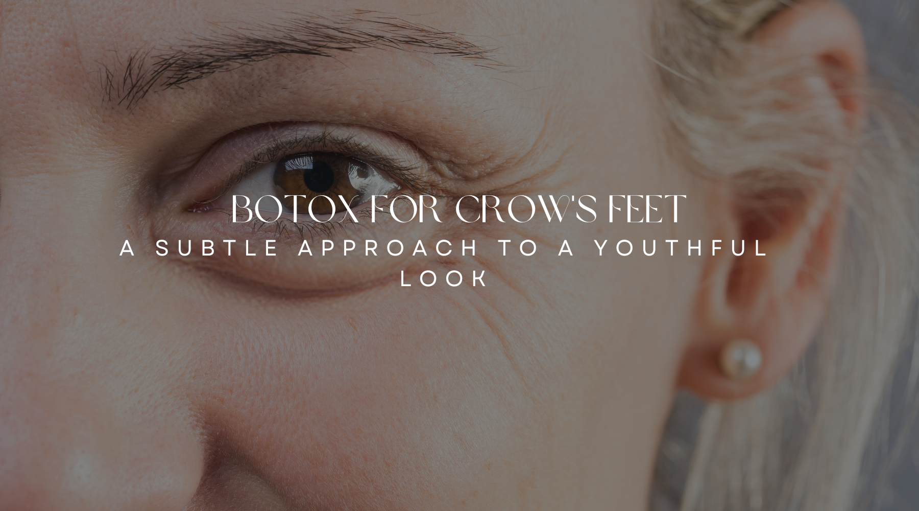 Botox for Crow's Feet: A Subtle Approach to a Youthful Look
