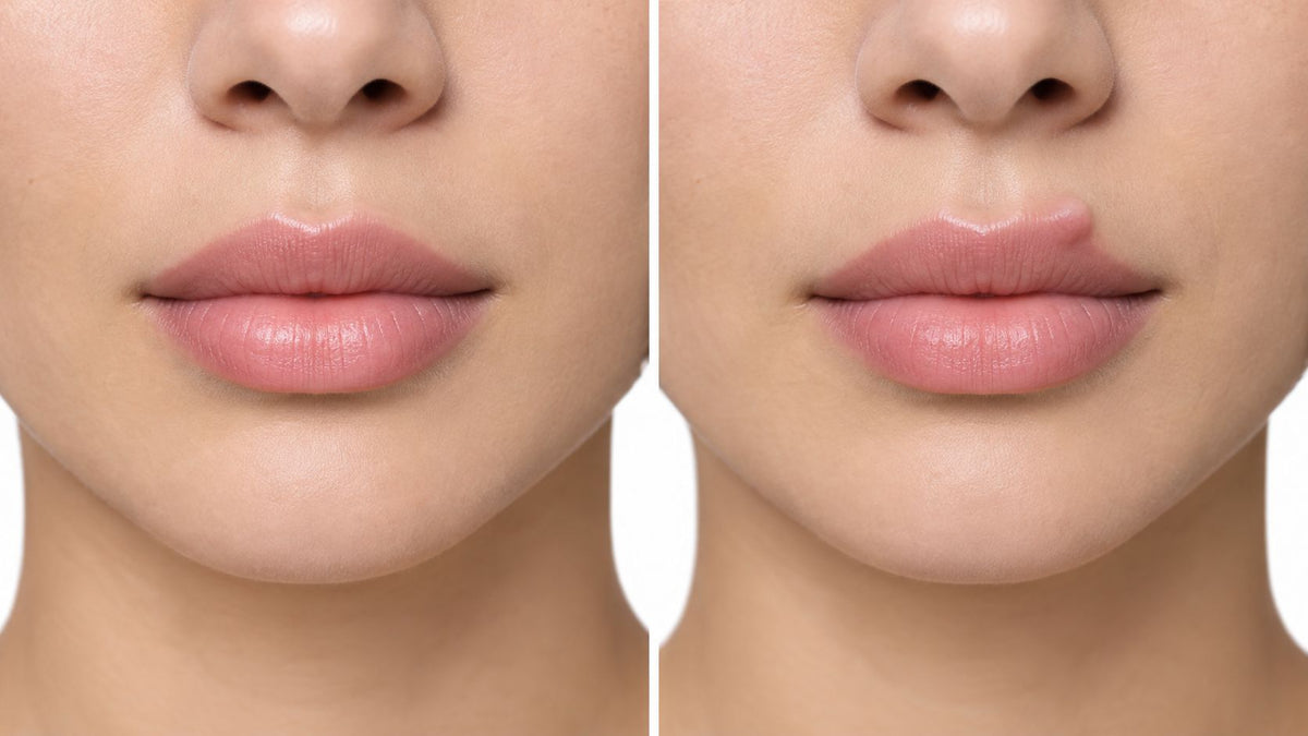 Signs of Lip Filler Migration: What You Should Know