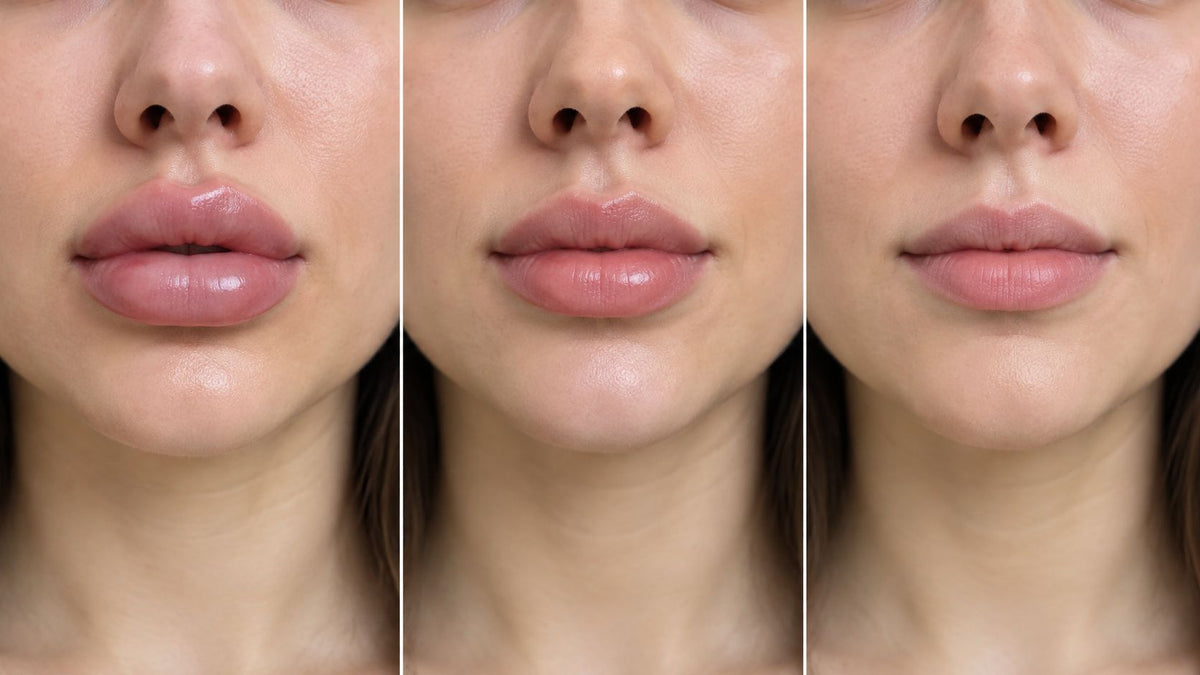 Lip Filler Swelling Day by Day: A Timeline and Red Flags