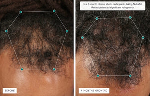 Nutrafol Men - Growth Pack (3 month supply) - BotoxBarb 